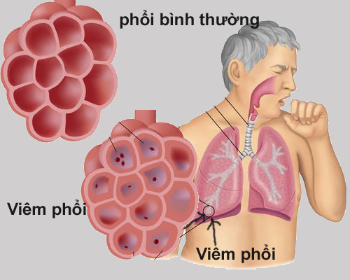 Ảnh 4 của Viêm phổi do nấm